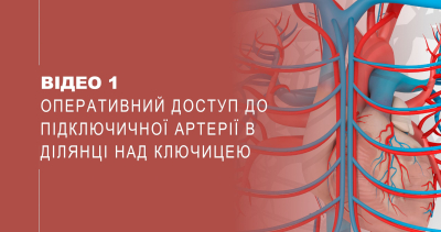 Відео 1. Оперативний доступ до  підключичної артерії в ділянці над ключицею