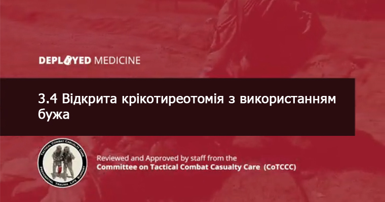 3.4 Відкрита крікотиреотомія з використанням бужа