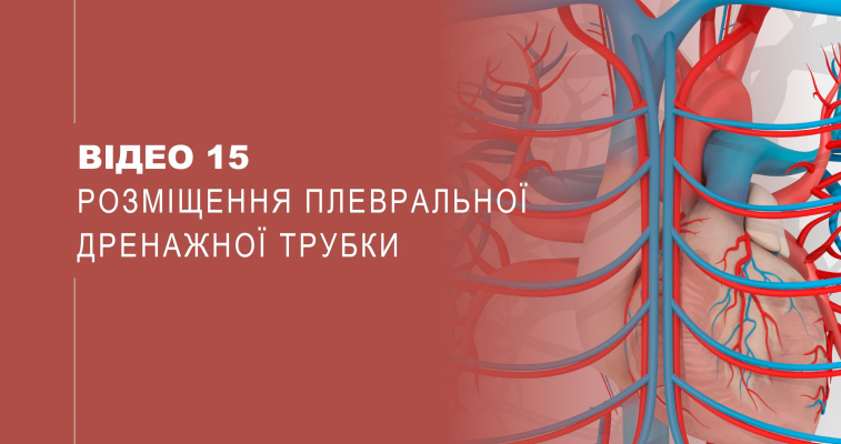 Відео 15. Розміщення плевральної дренажної трубки