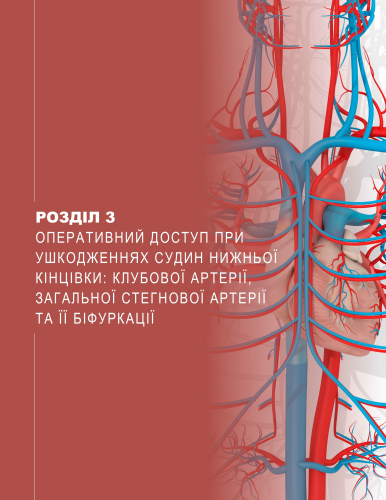 Розділ 3 Оперативний доступ при ушкодженнях судин нижньої кінцівки: клубової артерії, загальної стегнової артерії та її біфуркації