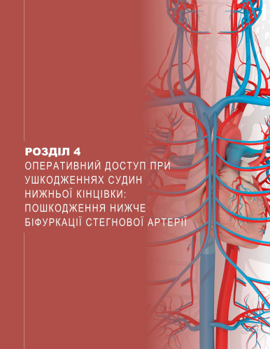 Розділ 4 Оперативний доступ при ушкодженнях судин нижньої кінцівки: пошкодження нижче біфуркації стегнової артерії