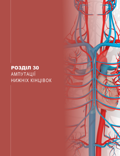 Розділ 30 Ампутації нижніх кінцівок