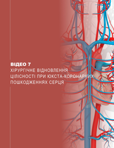 Відео 7. Хірургічне відновлення цілісності при юкста-коронарних пошкодженнях серця