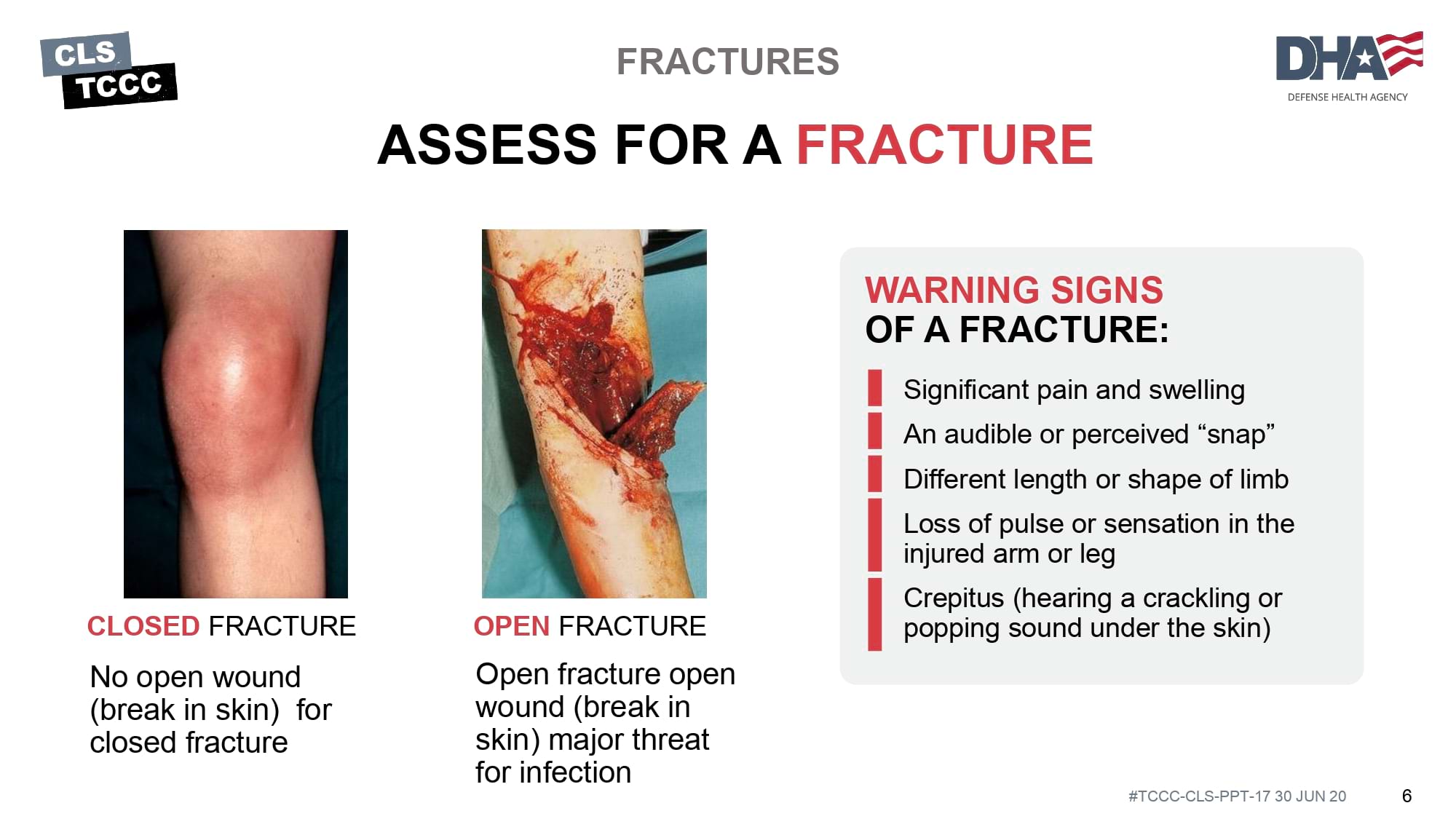 module-17-fractures-splinting-slide-06