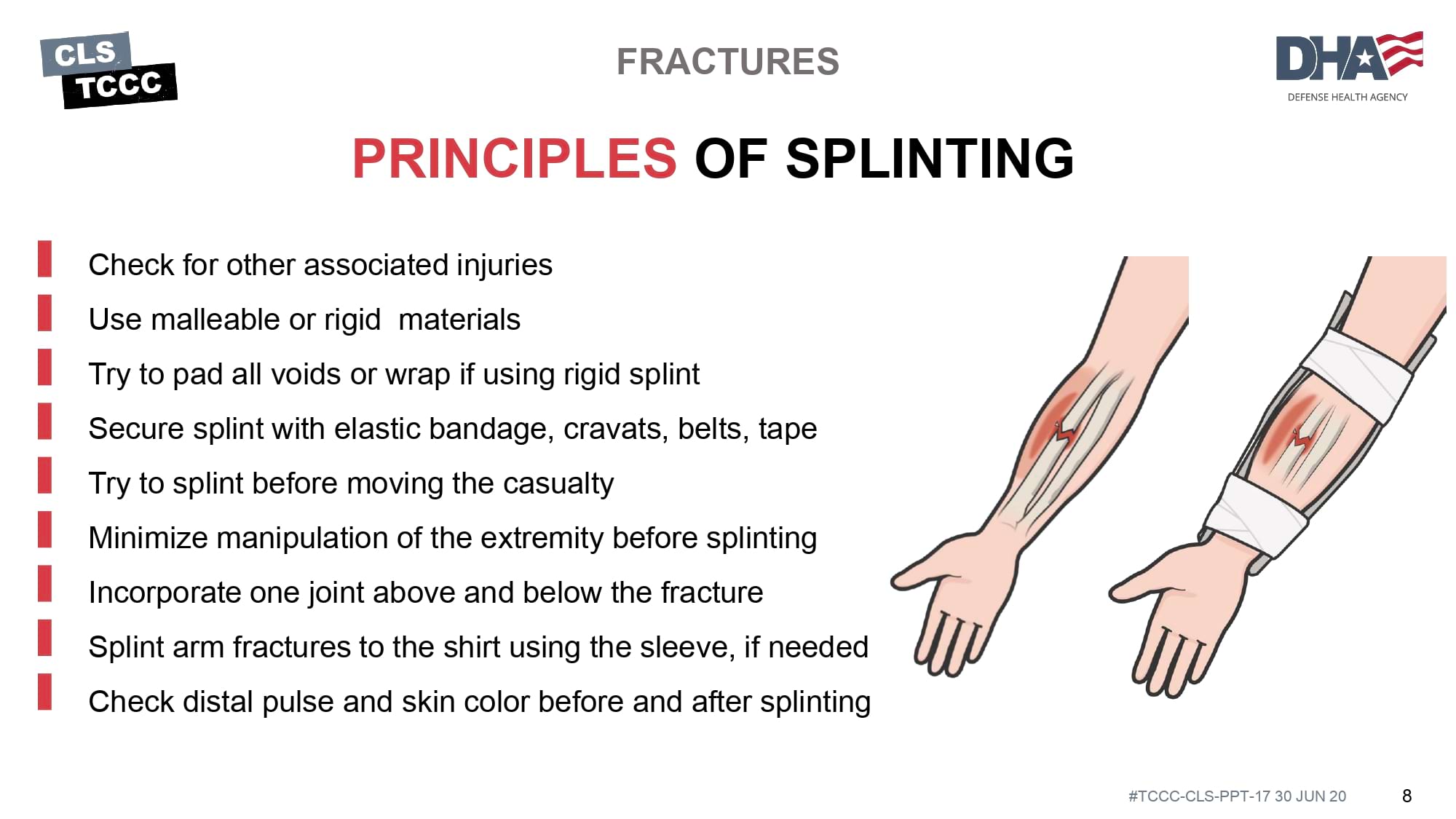 module-17-fractures-splinting-slide-08