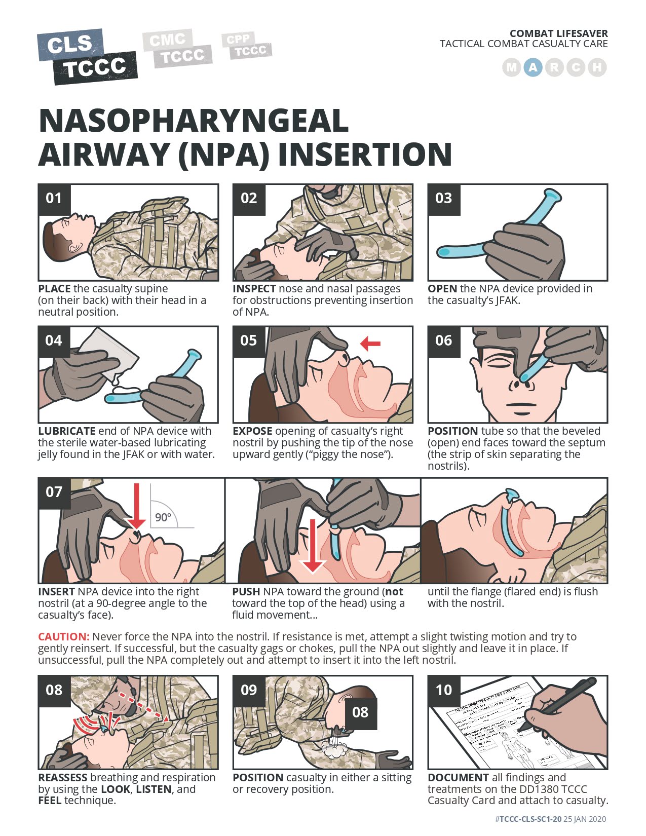 Nasopharyngeal Airway (NPA) Insertion
