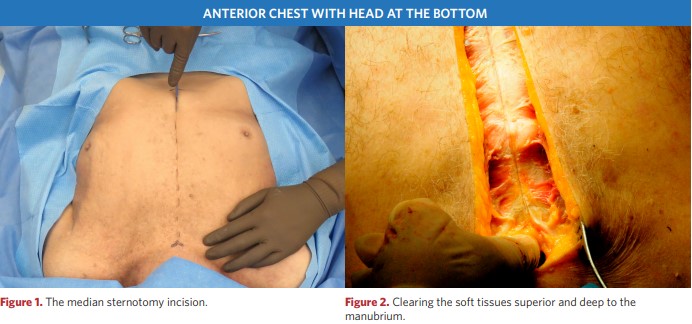 Median sternotomy