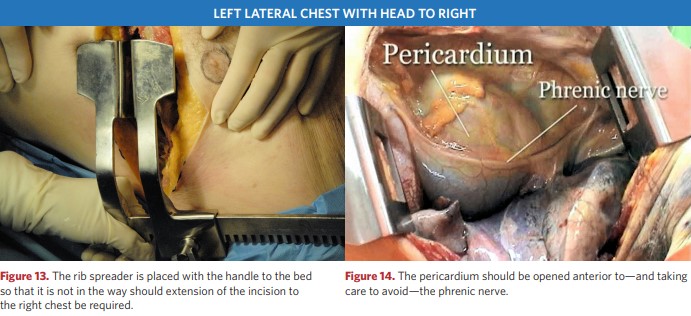 Resuscitation thoracotomy - continued