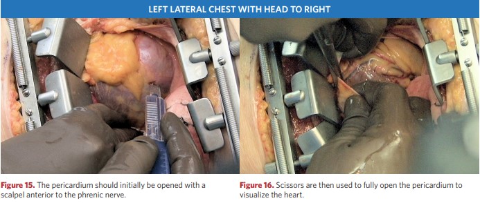 Use scissors to completely open the pericardium