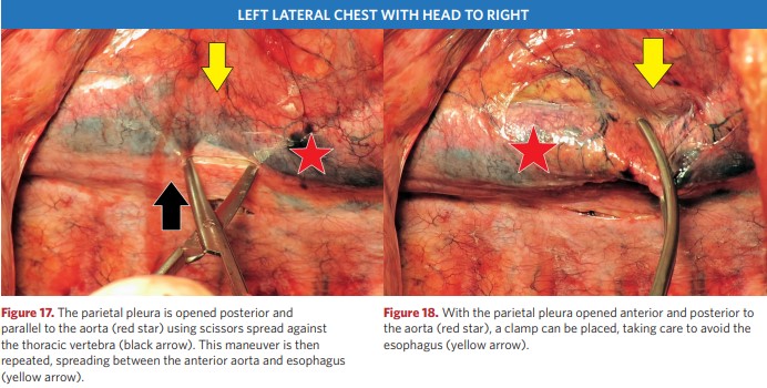 Open the parietal pleura