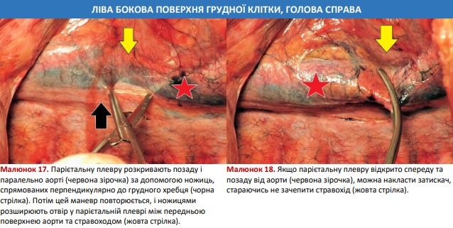 Розкривають парієтальну плевру