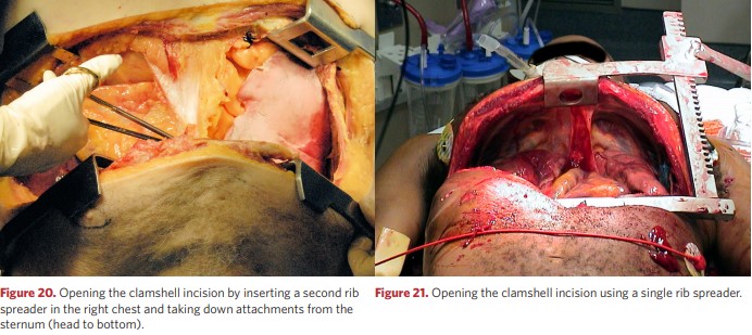 Extension of the clamshell incision