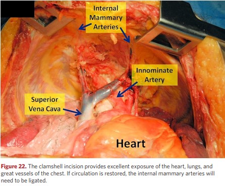 Access to the heart, lungs and large vessels of the chest cavity