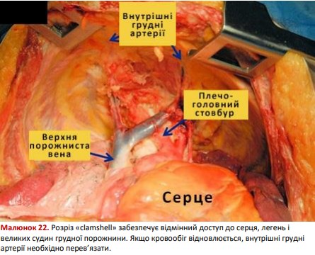 Доступ до серця, легень і великих судин грудної порожнини