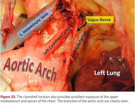 Access to the upper mediastinum and upper chest cavity