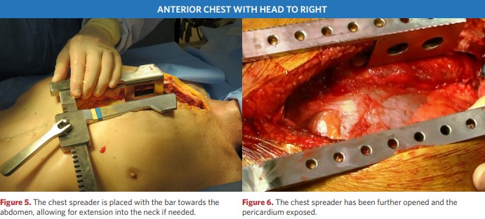 Thoracic retractor