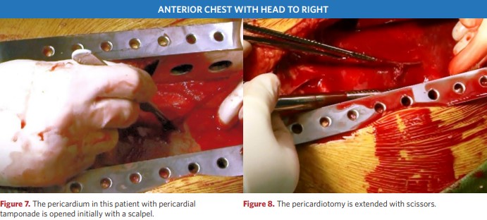 Pericardiotomy