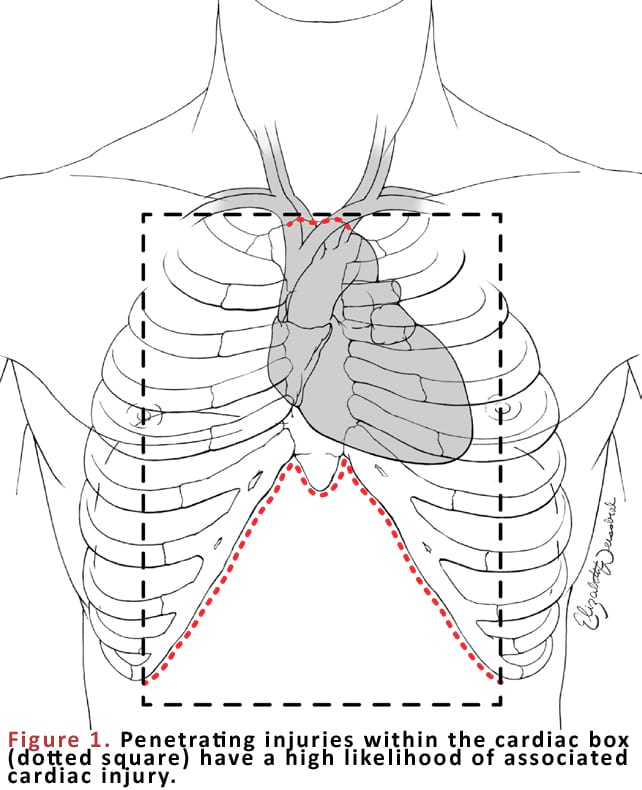 Penetrating injuries within the cardiac box (dotted square) have a high likelihood of associated cardiac injury