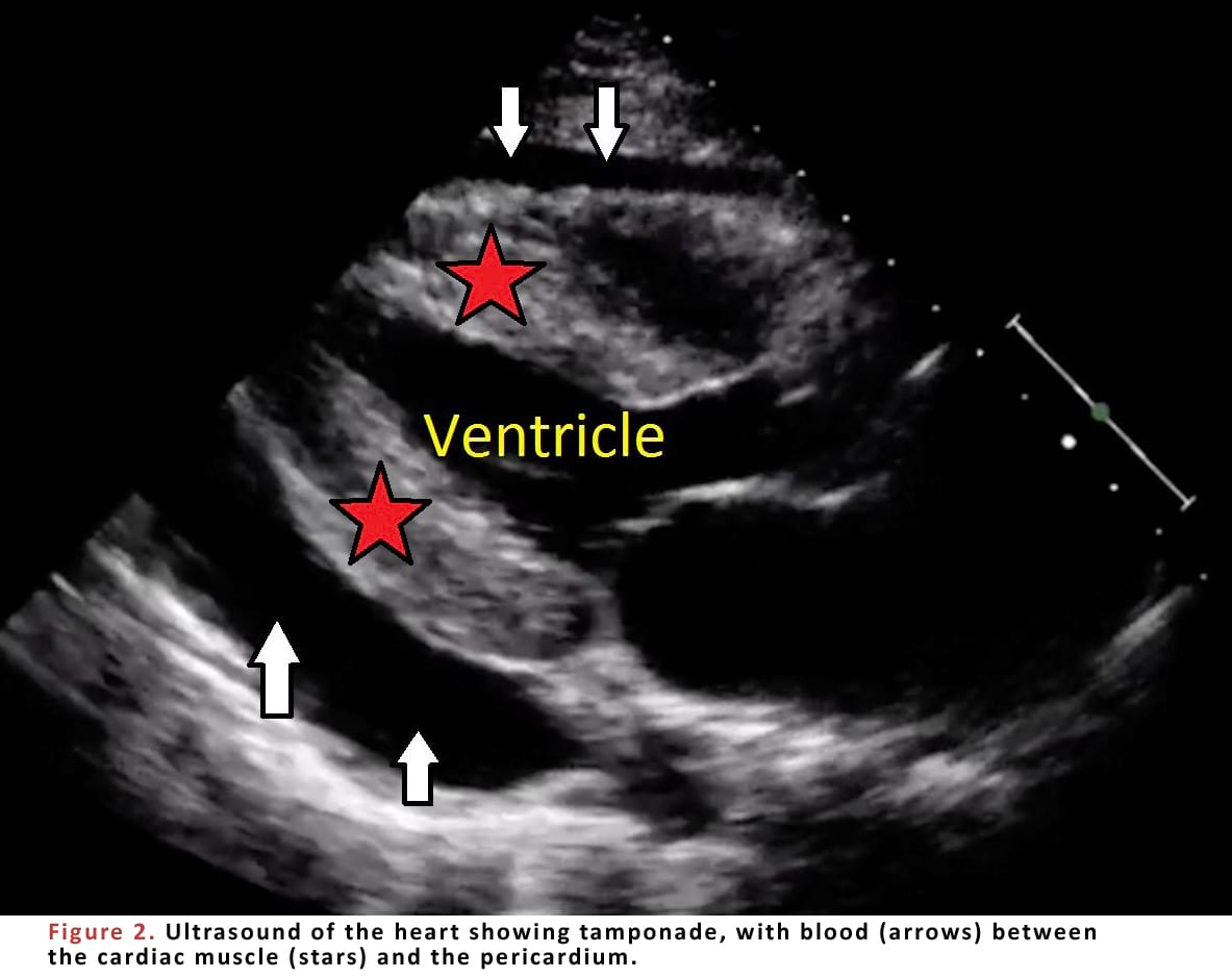 Ultrasound of the heart showing tamponade, with blood between the cardiac muscle and the pericardium.