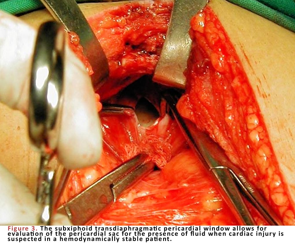 The subxiphoid transdiaphragmatic pericardial window