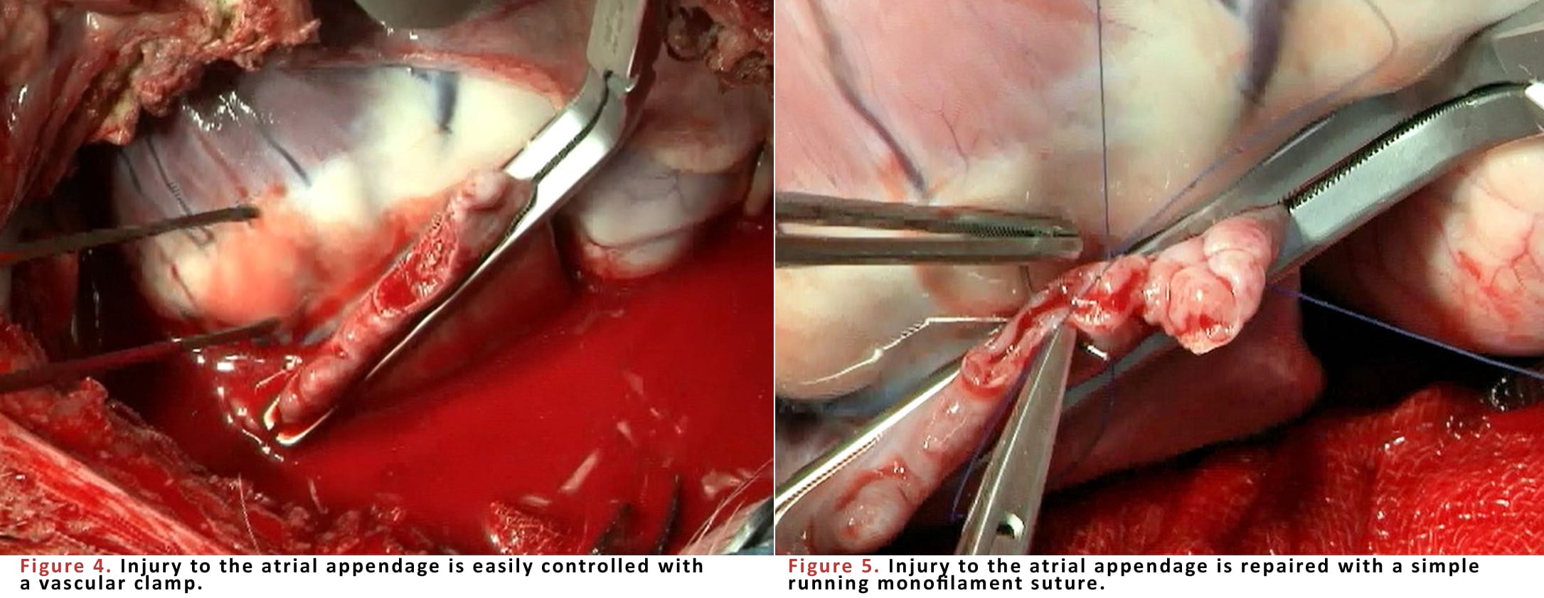 Injury to the atrial appendage