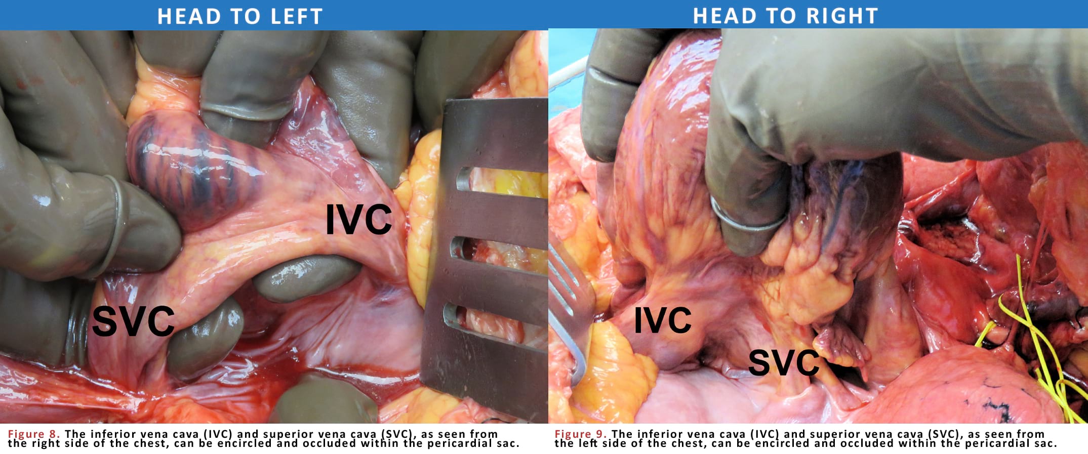 The inferior vena cava (IVC) and superior vena cava (SVC), as seen from the right(left) side of the chest, can be encircled and occluded within the pericardial sac