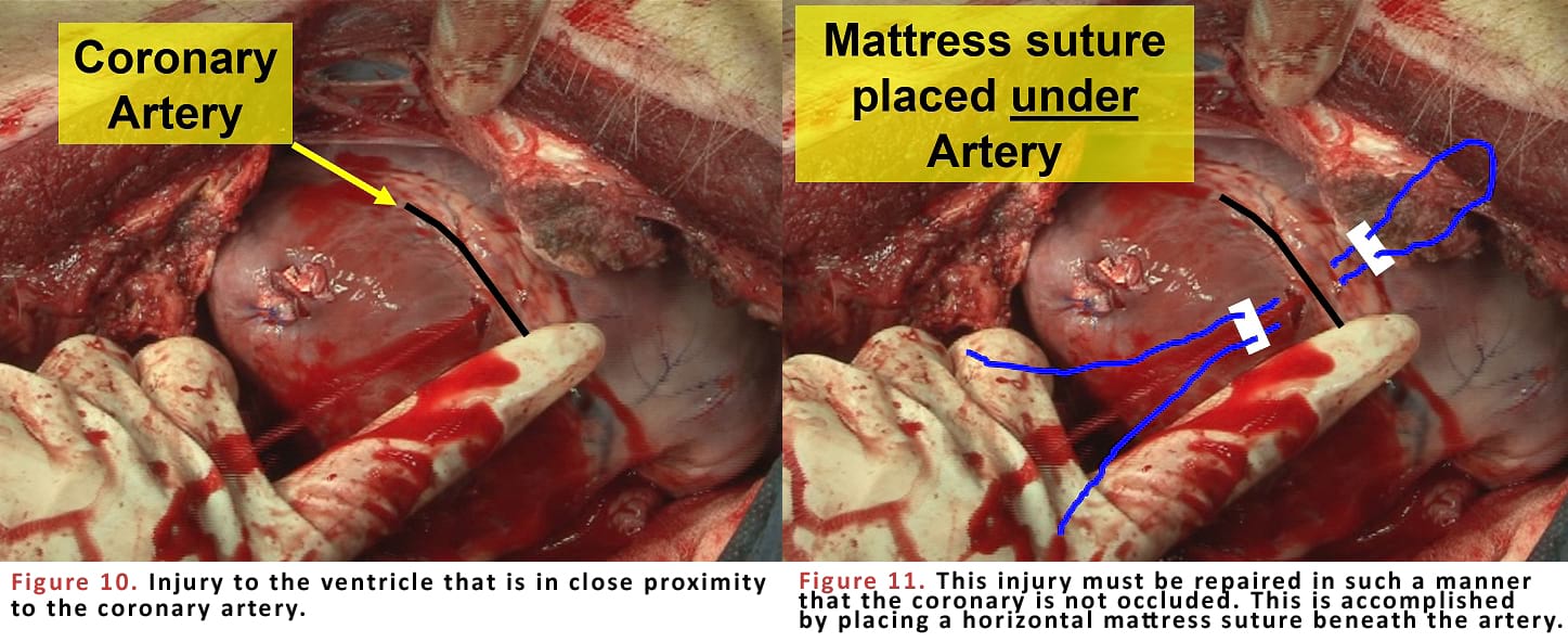 Injury to the ventricle that is in close proximity to the coronary artery