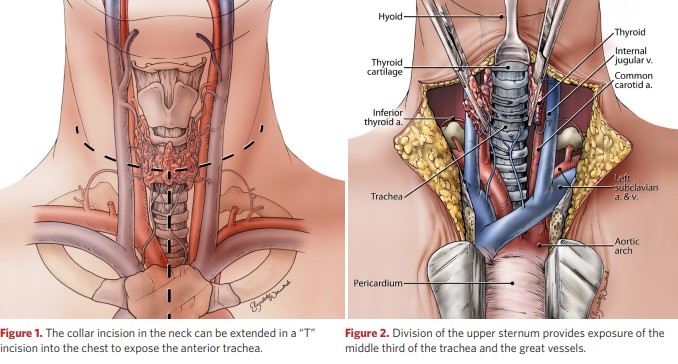 The collar incision in the neck