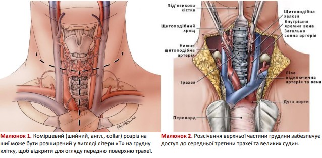 Комірцевий розріз на шиї