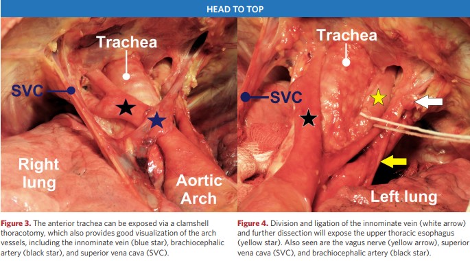 Division and ligation of the innominate vein