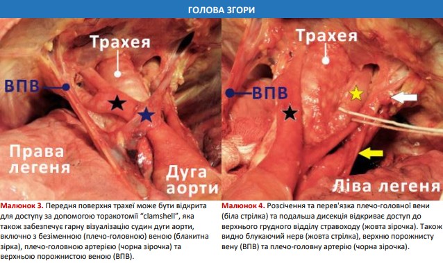 Перев'язка плечо-головної вени