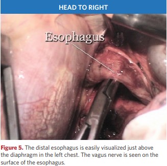 Esophagus