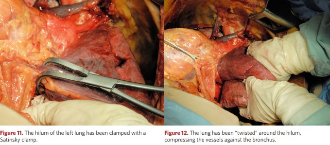 The lung has been “twisted” around the hilum