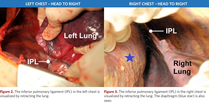 Inferior pulmonary ligament