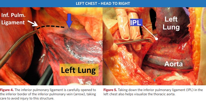 Dissection of the lower pulmonary ligament