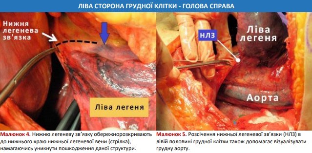 Розсічення нижньої легеневої зв’язки