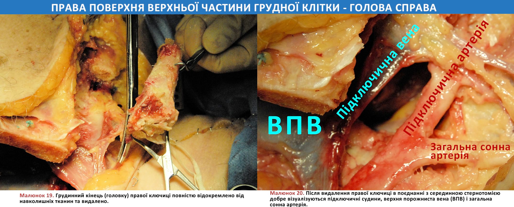 Грудинний кінець (головку) правої ключиці повністю відокремлено від навколишніх тканин та видалено