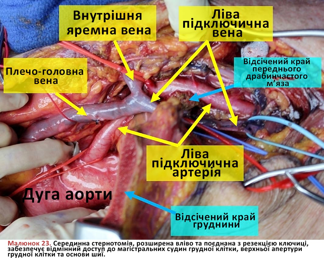 Серединна стернотомія, розширена вліво та поєднана з резекцією ключиці, забезпечує відмінний доступ до магістральних судин грудної клітки, верхньої апертури грудної клітки та основи шиї