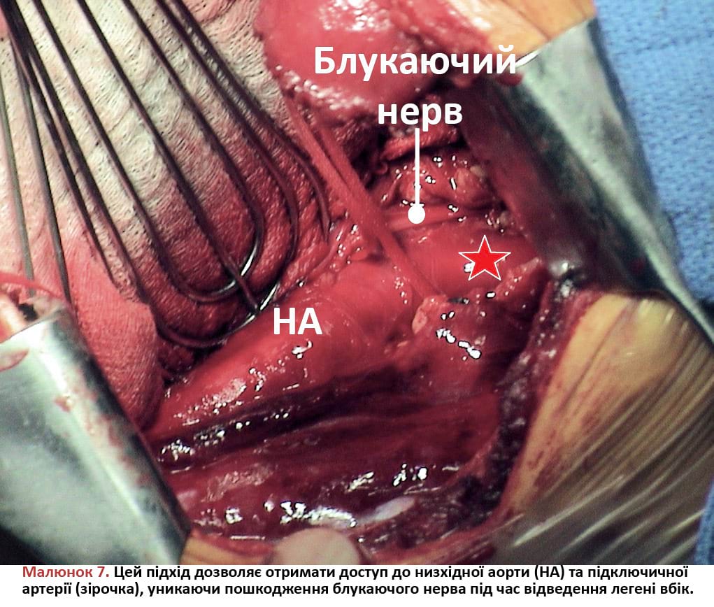 Підхід дозволяє отримати доступ до низхідної аорти та підключичної артерії, уникаючи пошкодження блукаючого нерва під час відведення легені вбік