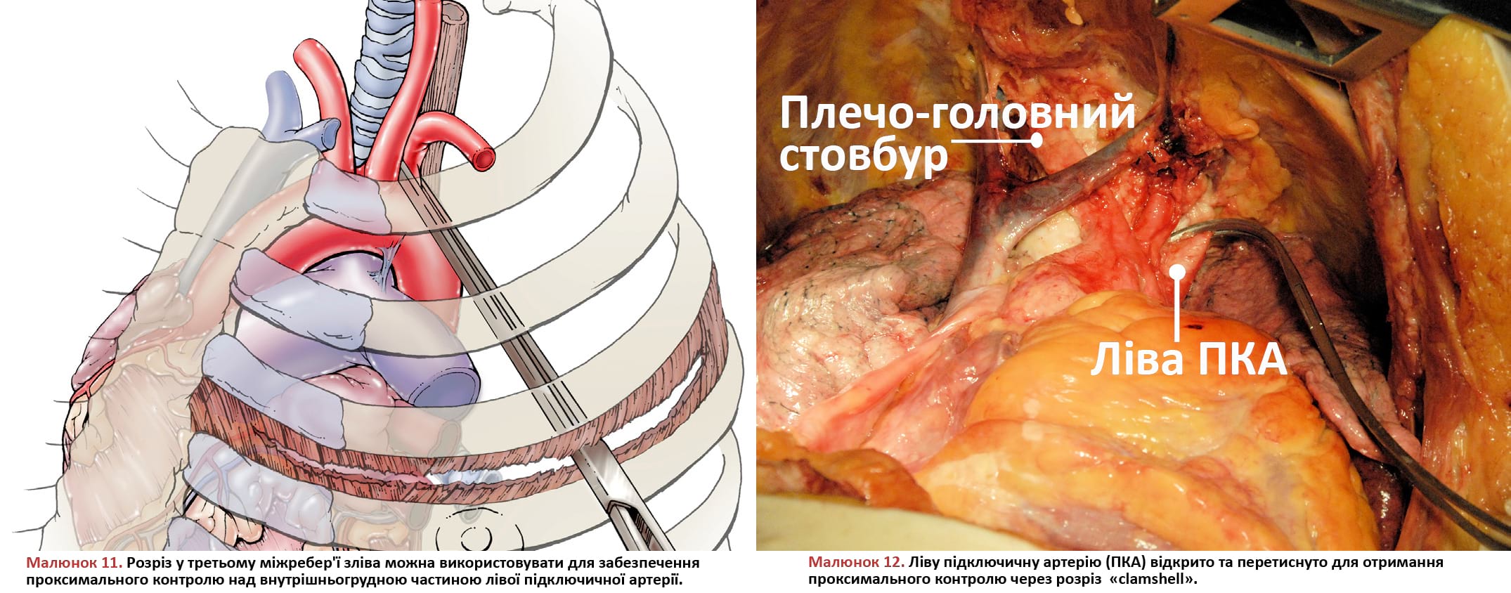 Розріз у третьому міжребер'ї зліва можна використовувати для забезпечення проксимального контролю над внутрішньогрудною частиною лівої підключичної артерії