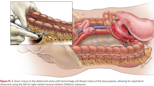 The left-to-right medial visceral rotation (Mattox) maneuver