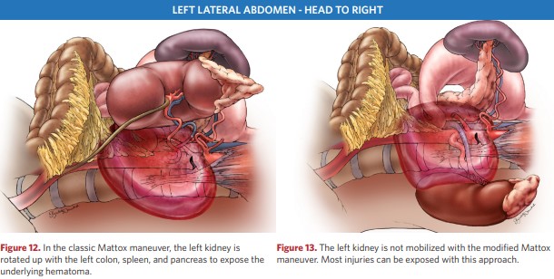 Classic and modified Mattox manoeuvre