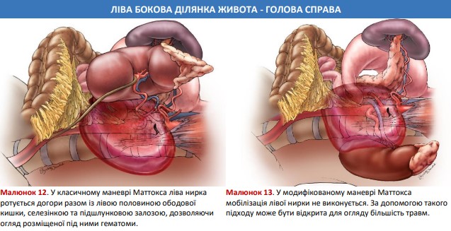 Класичний та модифікований маневр Маттокса