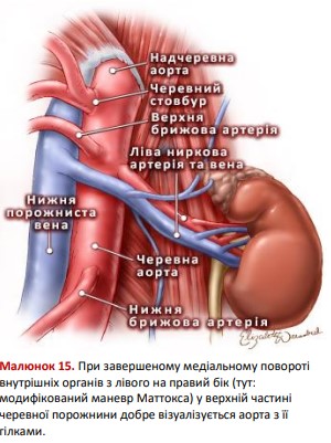 Модифікований маневр Маттокса - анатомія