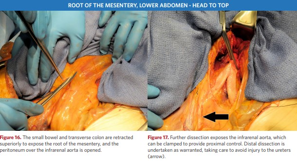 Root of the mesentery, lower abdomen