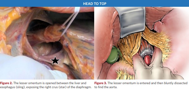 The lesser omentum