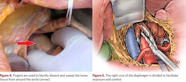 The right crus of the diaphragm is divided