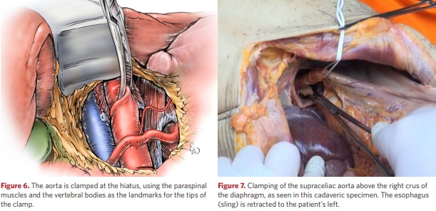 Clamping of the supraceliac aorta