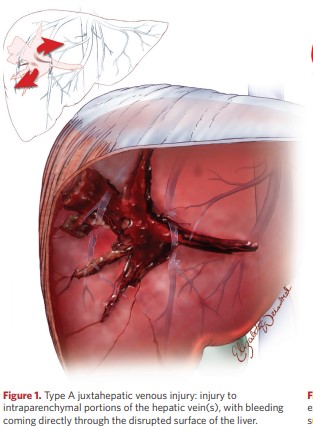 Type A juxtahepatic venous injury