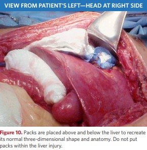 Tamponade of a wound in the liver